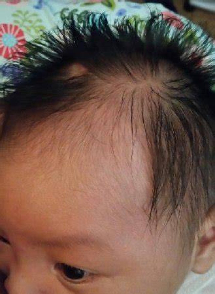 Bald Fetal