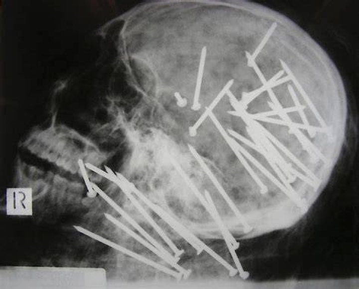 Crazy X-Rays Nail Through Face