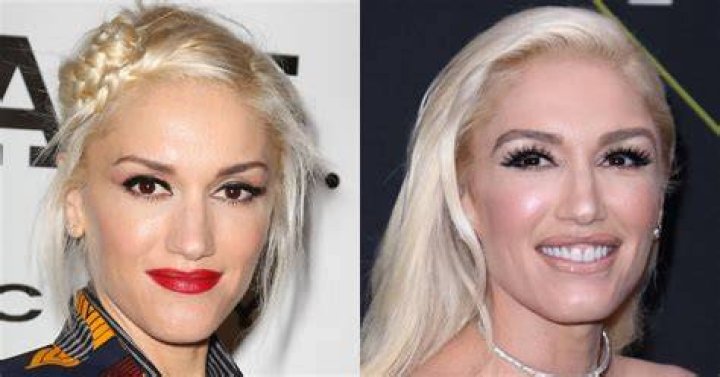 Experts Think Gwen Stefani Had ‘Botox’ and ‘Lip Augmentation’ — But Also Might Be Really Good at Contouring