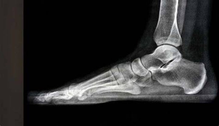 Fork In Foot Xray Image