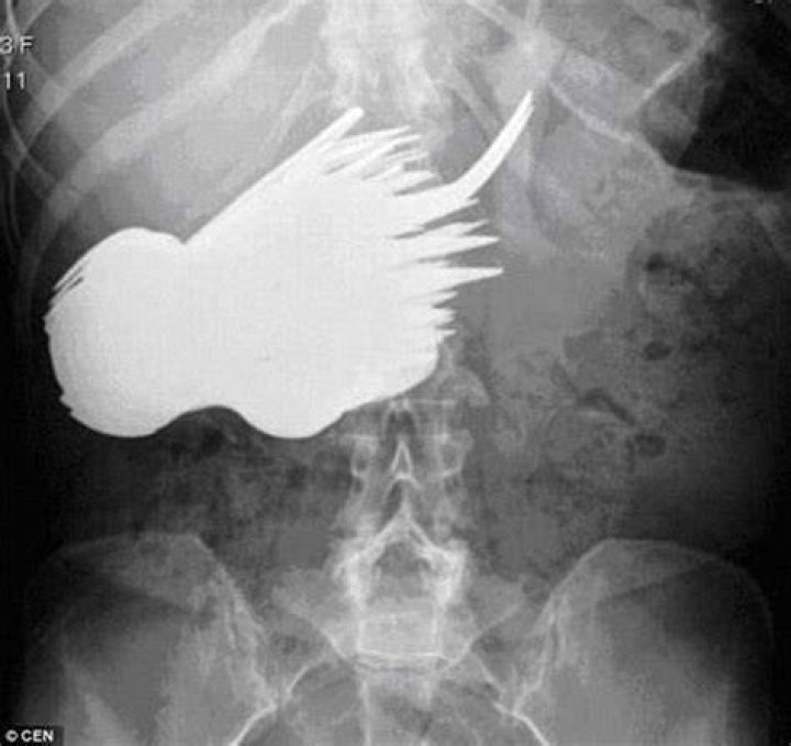 Funny Xray Images Swallowed Engagement Ring