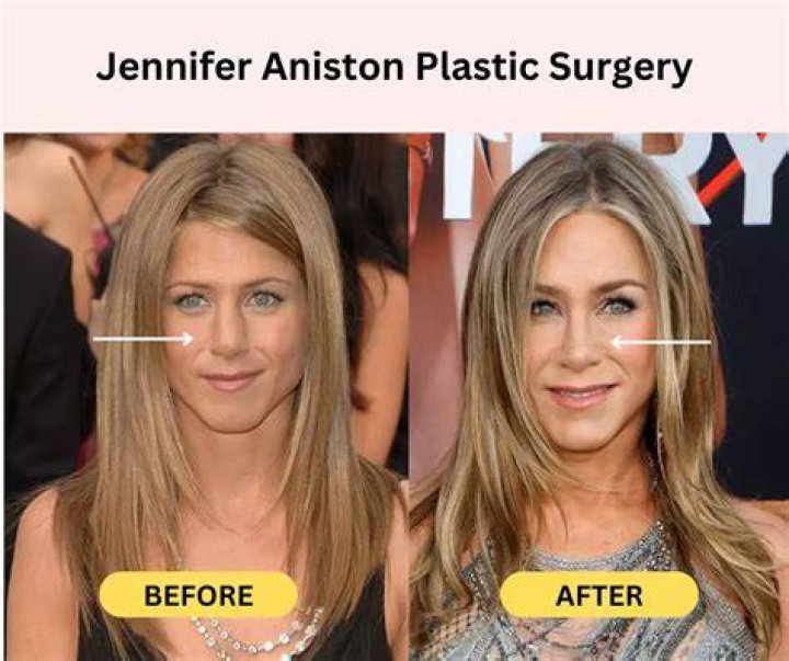 Jennifer underwent plastic surgery procedures
