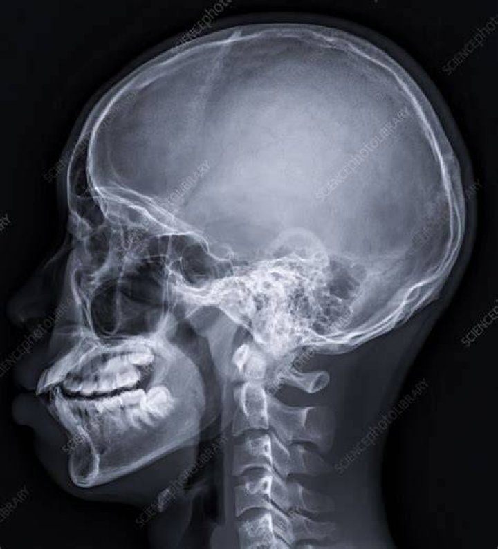 Knife In Head X-Ray