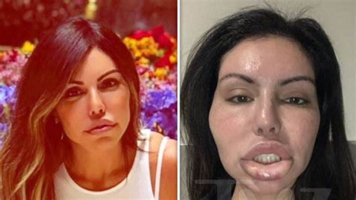 Liziane Gutierrez post surgery condition