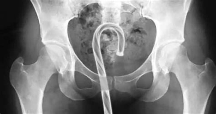 Weird X Rays Candy Cane