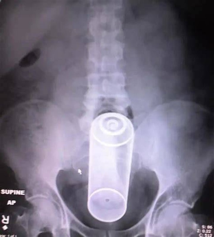Weird X Rays Nails