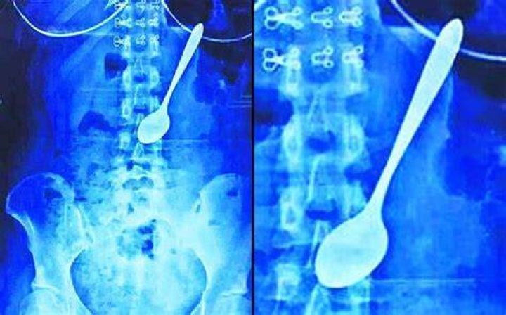Weird X Rays Spoon